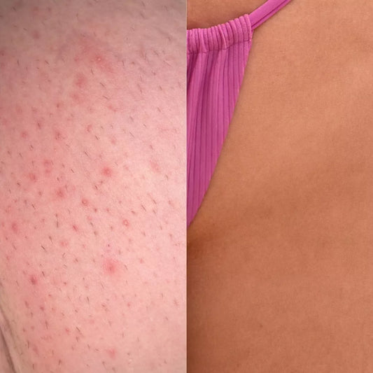 How to Trim Your Bikini Area Without Razor Burn or Ingrown Hairs